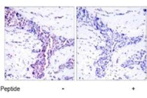 Immunohistochemical analysis of paraffin-embedded human breast carcinoma tissue using ATF2 polyclonal antibody  . (ATF2 抗体)
