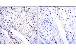 Immunohistochemistry analysis of paraffin-embedded human breast carcinoma tissue, using STAT3 (Ab-705) Antibody. (STAT3 抗体)