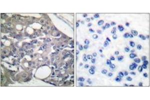 Immunohistochemistry analysis of paraffin-embedded human breast carcinoma, using SHP-1 (Phospho-Tyr536) Antibody. (SHP1 抗体  (pTyr536))
