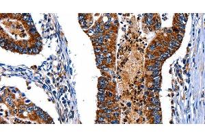 Immunohistochemistry of paraffin-embedded Human colon cancer tissue using ITGA7 Polyclonal Antibody at dilution 1:35 (ITGA7 抗体)