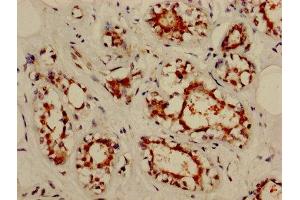 IHC image of ABIN7161970 diluted at 1:800 and staining in paraffin-embedded human breast cancer performed on a Leica BondTM system. (NOL3 抗体  (AA 1-208))