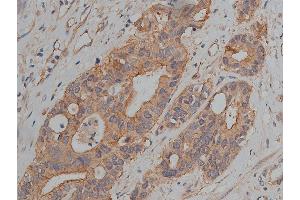 ABIN6269036 at 1/200 staining human colon cancer tissue sections by IHC-P. (JUP 抗体  (C-Term))