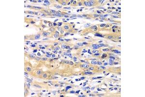 Immunohistochemistry of paraffin-embedded human gastric cancer using SARS antibody. (Seryl-tRNA Synthetase (SARS) (AA 1-300) 抗体)
