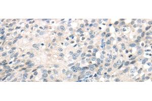 Immunohistochemistry of paraffin-embedded Human ovarian cancer using IQGAP2 Polyclonal Antibody at dilution of 1/40 (IQGAP2 抗体)