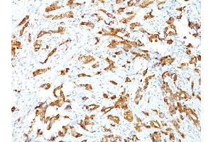 Formalin-fixed, paraffin-embedded human Breast Carcinoma stained with HSP27 Monoclonal Antibody (G3. (HSP27 抗体)