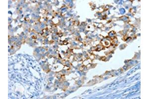 The image on the left is immunohistochemistry of paraffin-embedded Human breast cancer tissue using ABIN7130299(MUC15 Antibody) at dilution 1/25, on the right is treated with fusion protein. (MUC15 抗体)