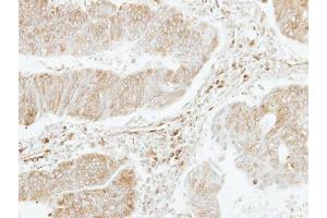 IHC-P Image Immunohistochemical analysis of paraffin-embedded human colon carcinoma, using PF4V1, antibody at 1:250 dilution.
