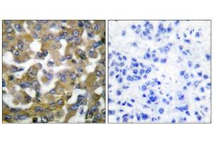 Immunohistochemical analysis of paraffin-embedded human breast carcinoma tissue using Keratin 19 antibody (ABIN5976439). (Cytokeratin 19 抗体  (Internal Region))