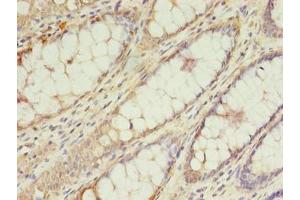 Immunohistochemistry of paraffin-embedded human colon cancer using ABIN7173516 at dilution of 1:100 (TRNAU1AP 抗体  (AA 33-156))
