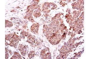 IHC-P Image EIF4E2 antibody [N1C3] detects EIF4E2 protein at cytoplasm on human breast carcinoma by immunohistochemical analysis. (EIF4E2 抗体)