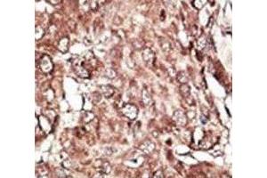 IHC analysis of FFPE human hepatocarcinoma stained with the PRMT7 antibody (PRMT7 抗体  (AA 1-30))
