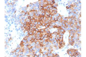 Formalin-fixed, paraffin-embedded human bladder carcinoma stained with Tubulin beta 3 Mouse Monoclonal Antibody (TUBB3/3732). (TUBB3 抗体  (AA 437-450))