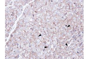 IHC-P Image Immunohistochemical analysis of paraffin-embedded CL1-0 xenograft, using SCARA3, antibody at 1:100 dilution. (SCARA3 抗体)