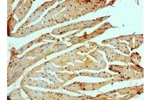 Immunohistochemistry of paraffin-embedded human prostate cancer using ABIN7151465 at dilution of 1:100 (GCN2 抗体  (AA 1-300))