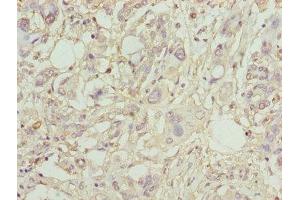 Immunohistochemistry of paraffin-embedded human pancreatic cancer using ABIN7163613 at dilution of 1:100 (PLA2G7 抗体  (AA 49-441))