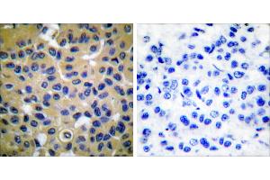 Peptide - +Immunohistochemical analysis of paraffin-embedded human breast carcinoma tissue using Collagen II antibody (#C0155). (COL2 抗体)