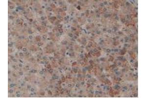 IHC-P analysis of Human Liver Cancer Tissue, with DAB staining. (PLAT 抗体  (AA 36-126))