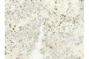 ABIN6263234 and ABIN6272659 at 1/100 staining human melanoma by IHC-P. (MFGE8 抗体  (C-Term))