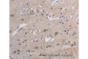 Immunohistochemistry of Human breast cancer using TONSL Polyclonal Antibody at dilution of 1:45 (NFKBIL2 抗体)