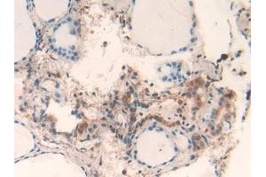 Detection of GAL2 in Human Thyroid Tissue using Polyclonal Antibody to Galectin 2 (GAL2) (Gallinacin-2 (GAL2) (AA 1-132) 抗体)