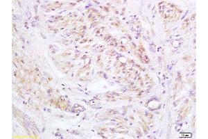 Formalin-fixed and paraffin embedded human cervical carcinoma labeled with Anti-PXMP1/ABCD3/PMP70 Polyclonal Antibody, Unconjugated  at 1:200 followed by conjugation to the secondary antibody and DAB staining. (PMP70 抗体  (AA 51-160))