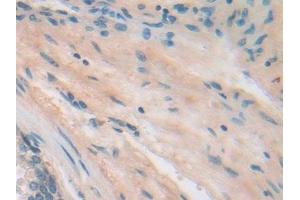 Detection of ITGb5 in Human Prostate Tissue using Polyclonal Antibody to Integrin Beta 5 (ITGb5) (Integrin beta 5 抗体  (AA 137-378))