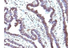 Formalin-fixed, paraffin-embedded human ovarian carcinoma stained with EMI1 antibody (EMI1/1176). (FBXO5 抗体  (AA 1-250))