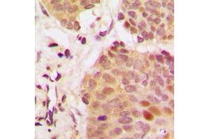 Immunohistochemical analysis of G3BP1 staining in human breast cancer formalin fixed paraffin embedded tissue section.
