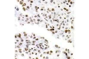 Immunohistochemistry of paraffin-embedded human liver cancer using NFKB2 Antibody (ABIN1873900) at dilution of 1:100 (40x lens). (NFKB2 抗体)