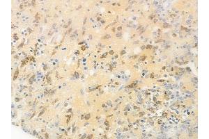 ABIN6255267 and ABIN6267477 at 1/100 staining human melanoma by IHC-P.