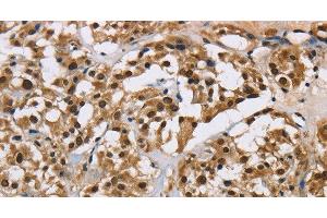 Immunohistochemistry of paraffin-embedded Human thyroid cancer using HNRNP L Polyclonal Antibody at dilution of 1:40 (HNRNPL 抗体)