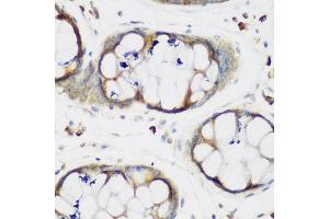 Immunohistochemistry of paraffin-embedded human gastric using MTDH antibody at dilution of 1:200 (40x lens). (MTDH 抗体)