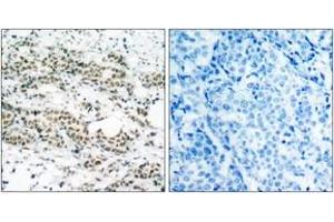 Immunohistochemistry analysis of paraffin-embedded human breast carcinoma, using AFX (Phospho-Ser197) Antibody. (FOXO4 抗体  (pSer197))