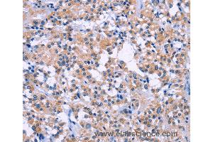 Immunohistochemistry of Human thyroid cancer using DUSP22 Polyclonal Antibody at dilution of 1:60 (DUSP22 抗体)