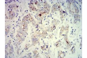 Immunohistochemical analysis of paraffin-embedded stomach cancer tissues using PCK2 mouse mAb with DAB staining. (PEPCK 抗体  (AA 44-175))