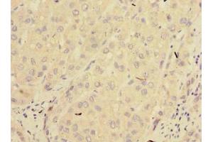Immunohistochemistry of paraffin-embedded human liver cancer using ABIN7165964 at dilution of 1:100 (PPM1M 抗体  (AA 1-247))