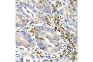 Immunohistochemistry of paraffin-embedded human gastric cancer using AIMP1 antibody. (AIMP1 抗体)