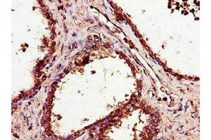 Immunohistochemistry of paraffin-embedded human prostate cancer using ABIN7170549 at dilution of 1:100 (SMS 抗体  (AA 16-191))