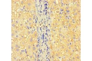 Immunohistochemistry of paraffin-embedded human liver cancer using ABIN7157130 at dilution of 1:100 (ISPD 抗体  (AA 1-264))