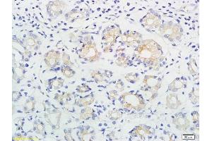 Formalin-fixed and paraffin embedded human gastric cancer labeled with Anti-ING1/p33 Polyclonal Antibody, Unconjugated (ABIN674514) followed by conjugation to the secondary antibody and DAB staining (ING1 抗体  (AA 301-422))