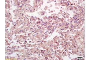 Formalin-fixed and paraffin embedded human lung carcinoma labeled with Anti-Phospho-ELk1(Ser383) Polyclonal Antibody, Unconjugated (ABIN1714907) at 1:200 followed by conjugation to the secondary antibody and DAB staining. (ELK1 抗体  (pSer383))