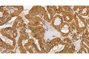 Immunohistochemistry of paraffin-embedded Human thyroid cancer tissue using PDP1 Polyclonal Antibody at dilution 1:30 (PDP 抗体)