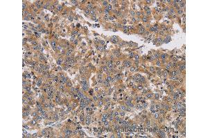 Immunohistochemistry of Human colon cancer using KCNG1 Polyclonal Antibody at dilution of 1:40 (KCNG1 抗体)