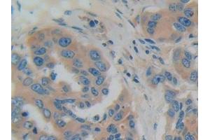 Detection of GDI1 in Human Breast cancer Tissue using Polyclonal Antibody to GDP Dissociation Inhibitor 1 (GDI1) (GDI1 抗体  (AA 1-274))