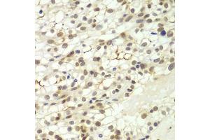 Immunohistochemistry of paraffin-embedded human kidney cancer using LHX4 antibody (ABIN6128183, ABIN6143193, ABIN6143194 and ABIN6224097) at dilution of 1:100 (40x lens). (LHX4 抗体  (AA 121-390))