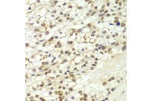 Immunohistochemistry of paraffin-embedded human kidney cancer using LHX4 antibody (ABIN6128183, ABIN6143193, ABIN6143194 and ABIN6224097) at dilution of 1:100 (40x lens). (LHX4 抗体  (AA 121-390))