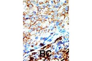 Formalin-fixed and paraffin-embedded human cancer tissue reacted with the primary antibody, which was peroxidase-conjugated to the secondary antibody, followed by AEC staining. (NME4 抗体  (C-Term))