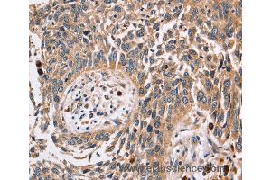 Immunohistochemistry of Human lung cancer using FUCA1 Polyclonal Antibody at dilution of 1:30