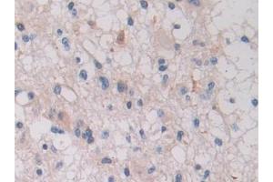 Detection of ITGb1 in Human Glioma Tissue using Polyclonal Antibody to Integrin Beta 1 (ITGb1) (ITGB1 抗体  (AA 140-383))