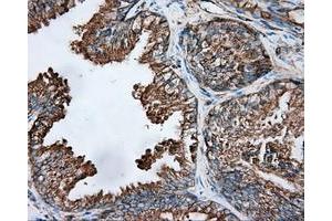 Immunohistochemical staining of paraffin-embedded Adenocarcinoma of ovary tissue using anti-TUBA8 mouse monoclonal antibody. (TUBA8 抗体)